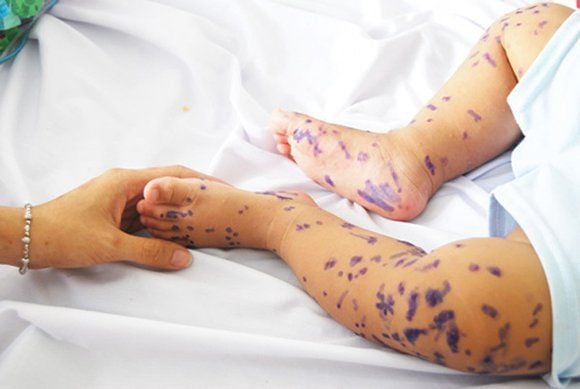 Công Dụng Của Thuốc Tím KMnO4 Trong Y Tế